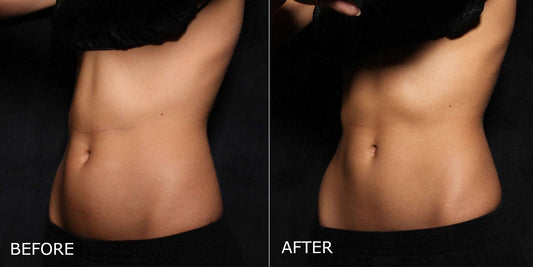 I Tried Emsculpt—a Body-Contouring Device—and Now I Have Actual Abs